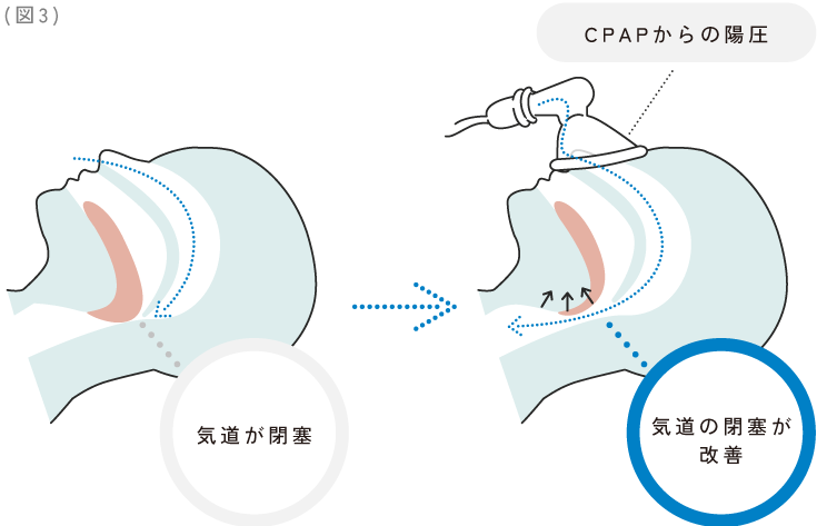 睡眠時無呼吸症候群08.png