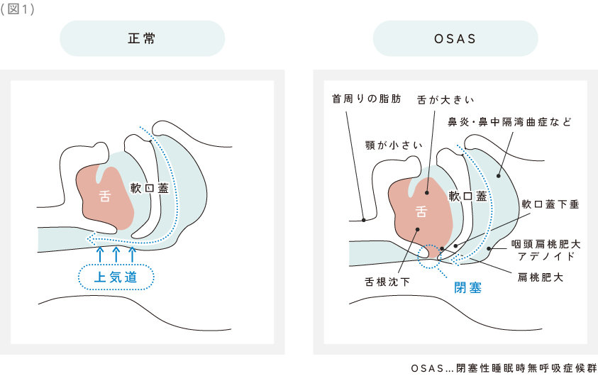 睡眠時無呼吸症候群01.jpg