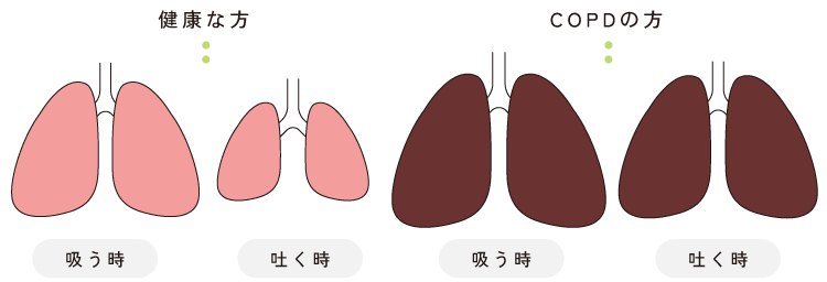 COPD肺気腫01.png